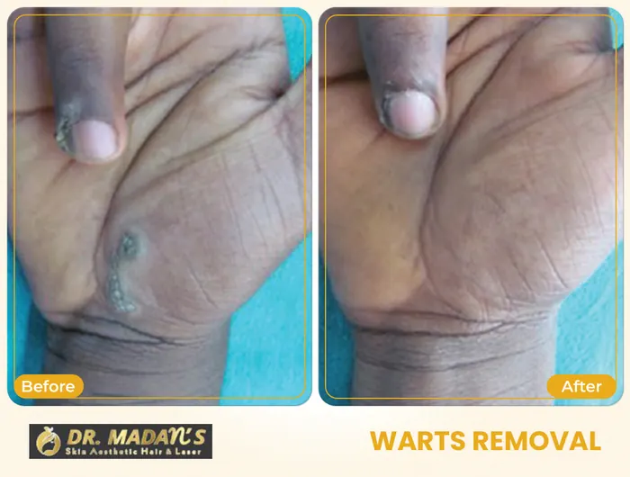 Warts removal before and after result 4 at Dr Madan Aesthetics